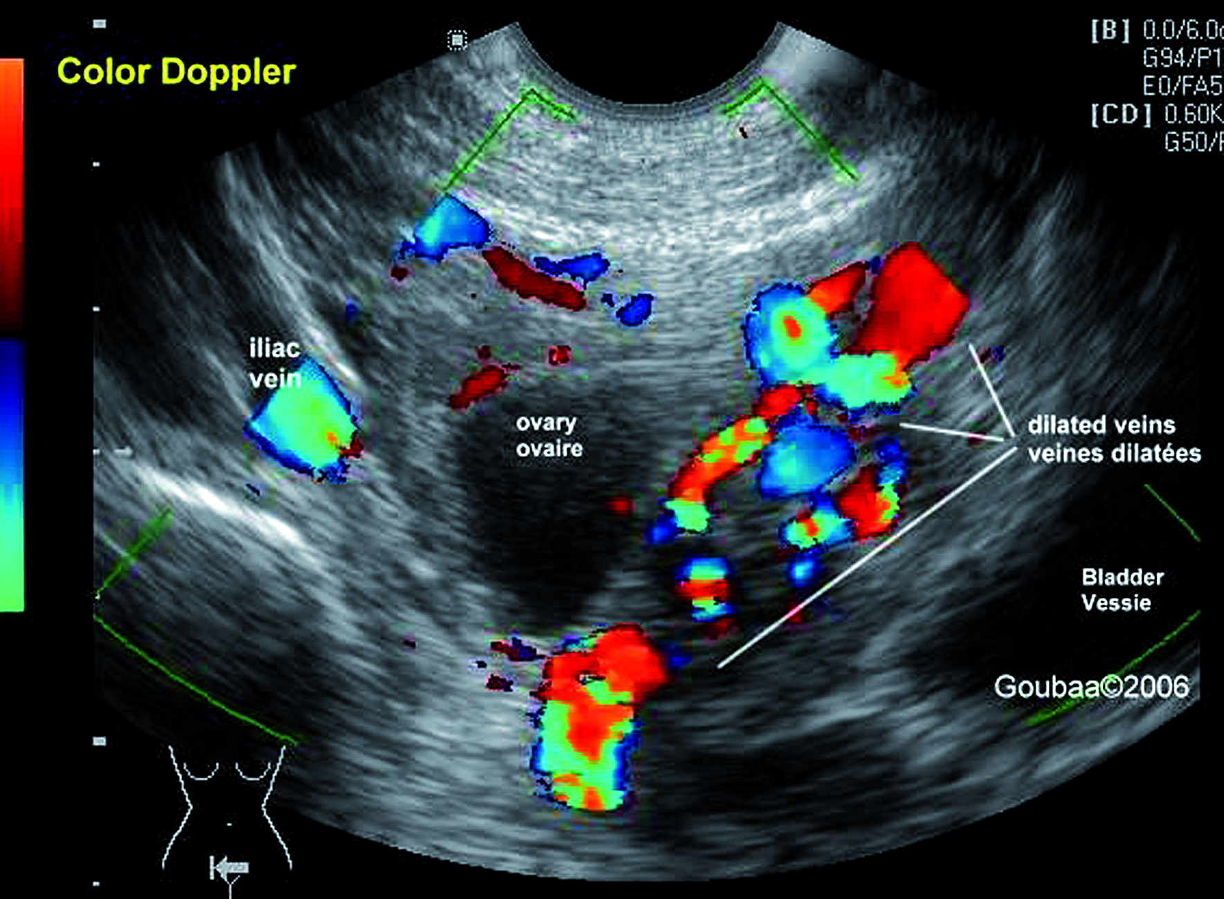 Ultrasound Mapping Sheet Endometriosis
